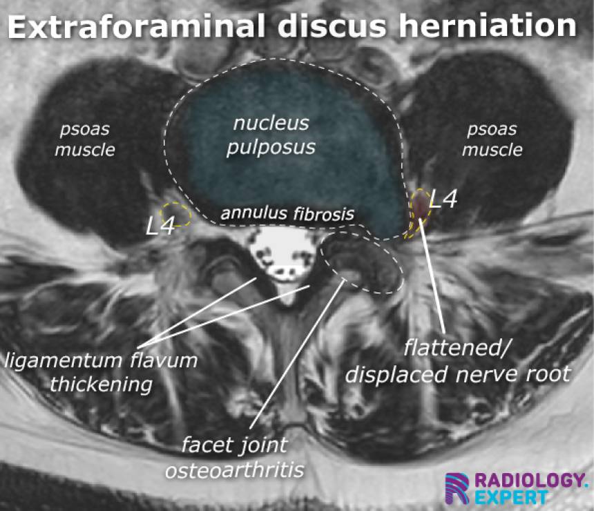 MRI Lumbar Spine mri-lumbar-spine